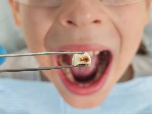 Best Broken Tooth Emergency  in Lake Vla, IL